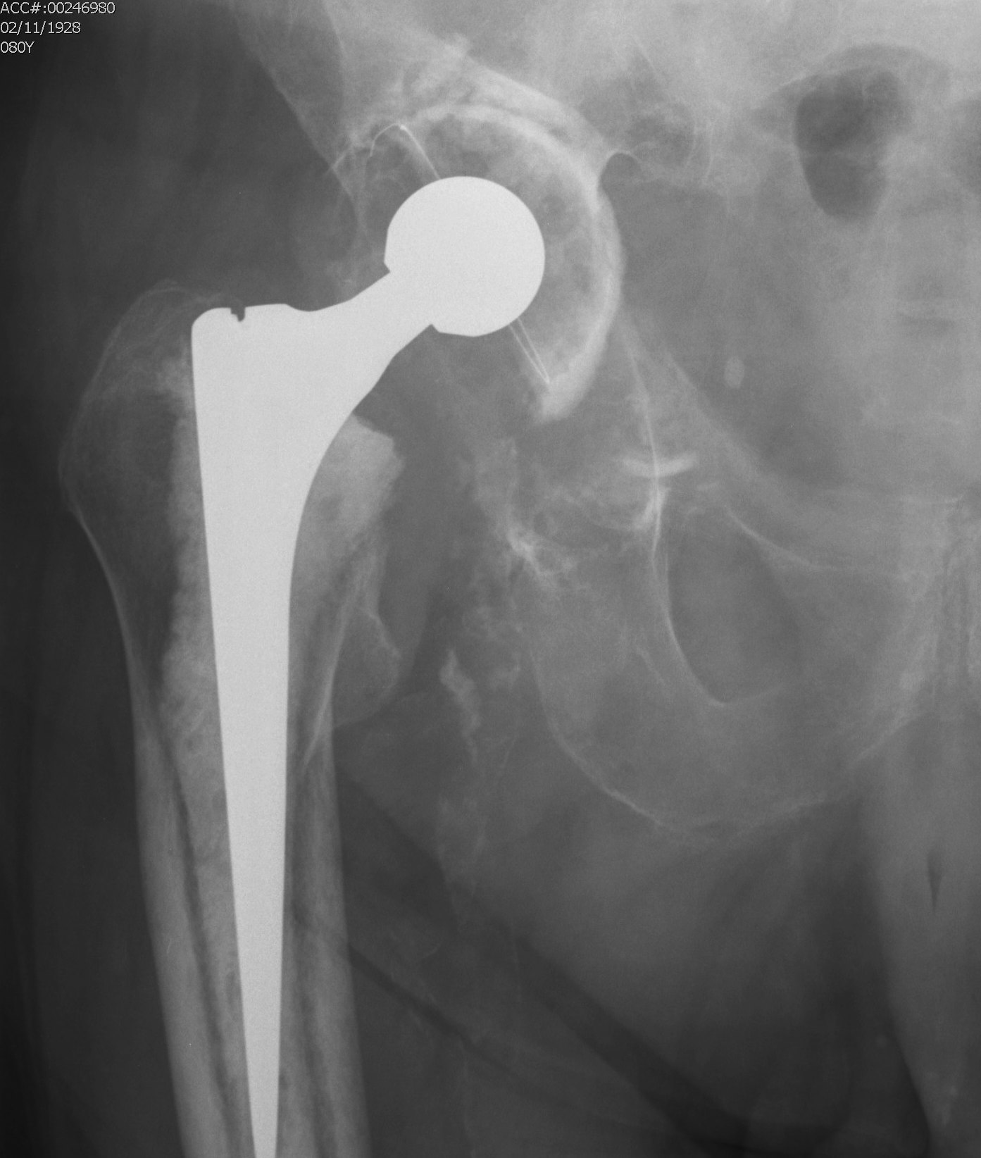 Revision THR Type 3 Acetabulum